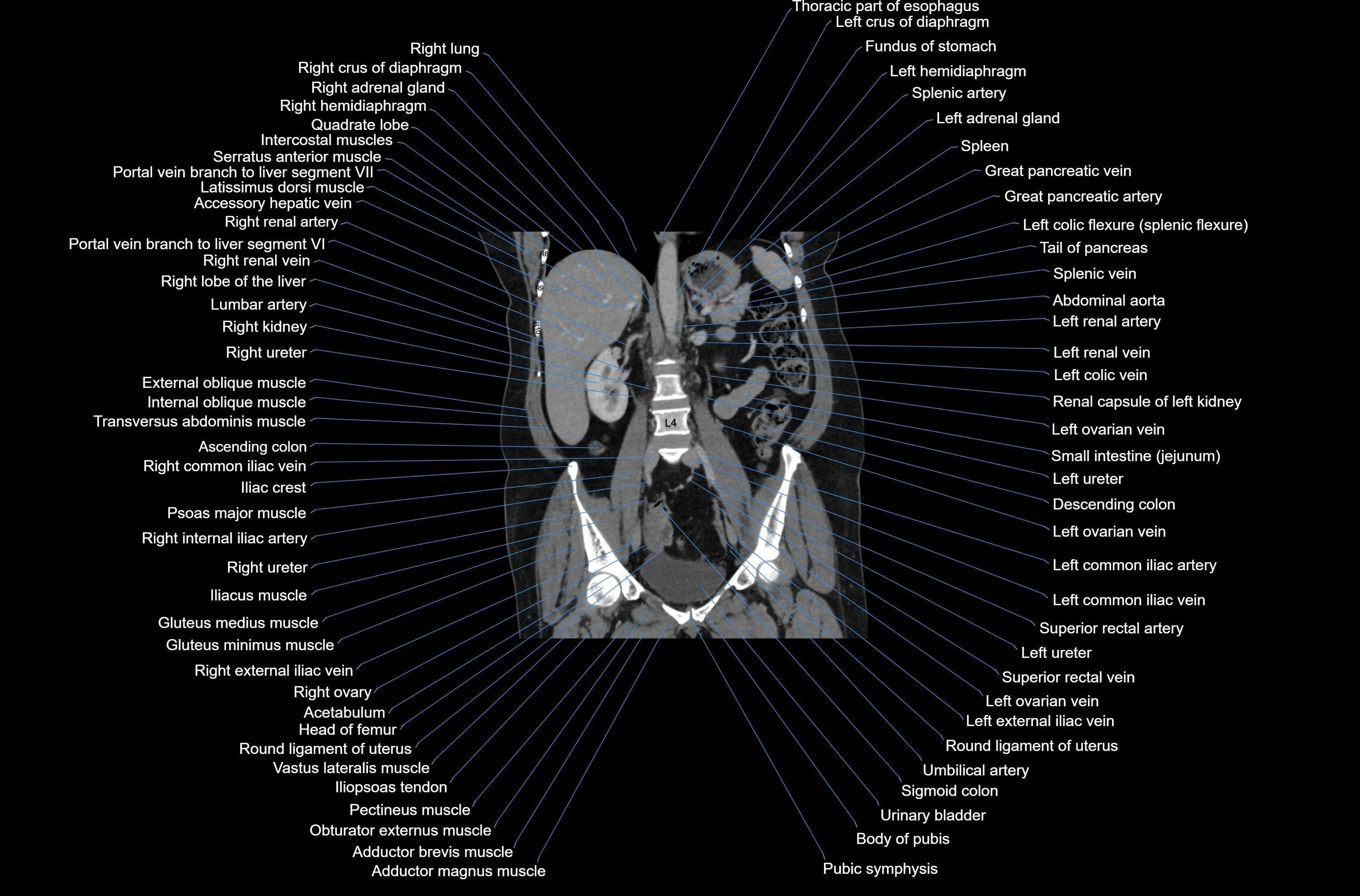 CT abdomen coronal cross sectional anatomy labelled radiology image-00049.webp